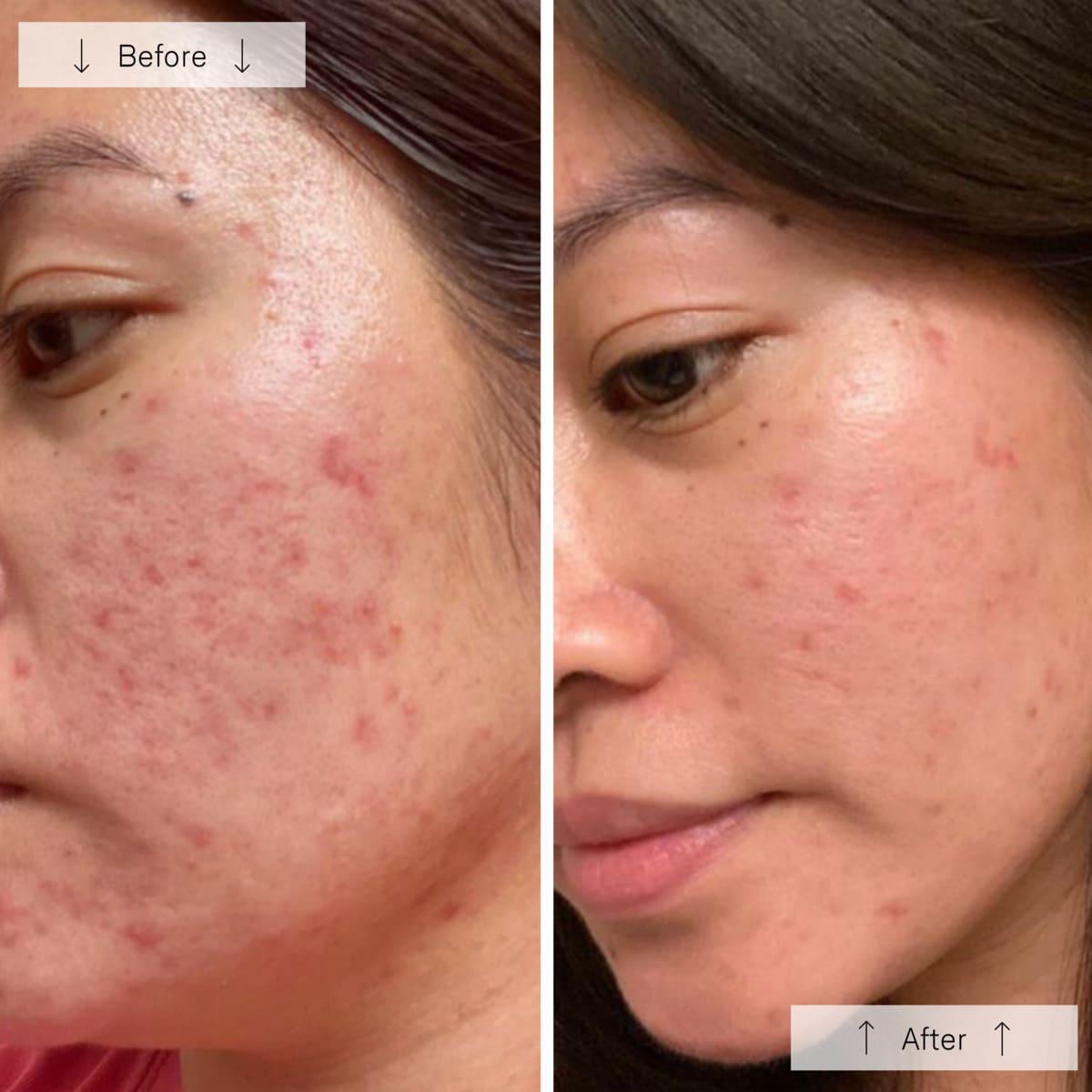 Omnilux Clear LED Mask