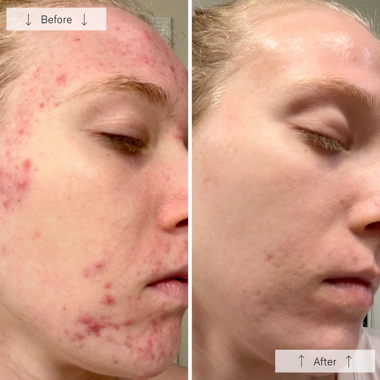 Omnilux Clear LED Mask