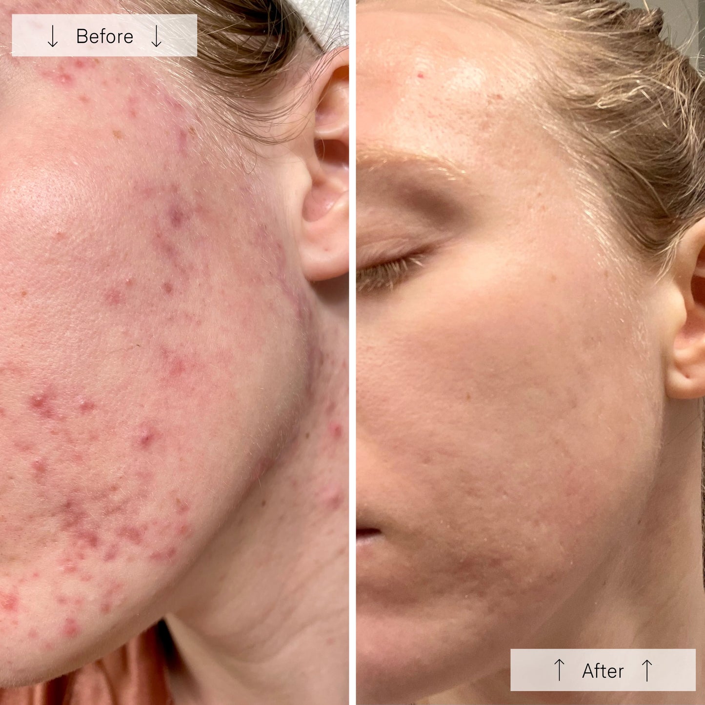 Omnilux Clear LED Mask