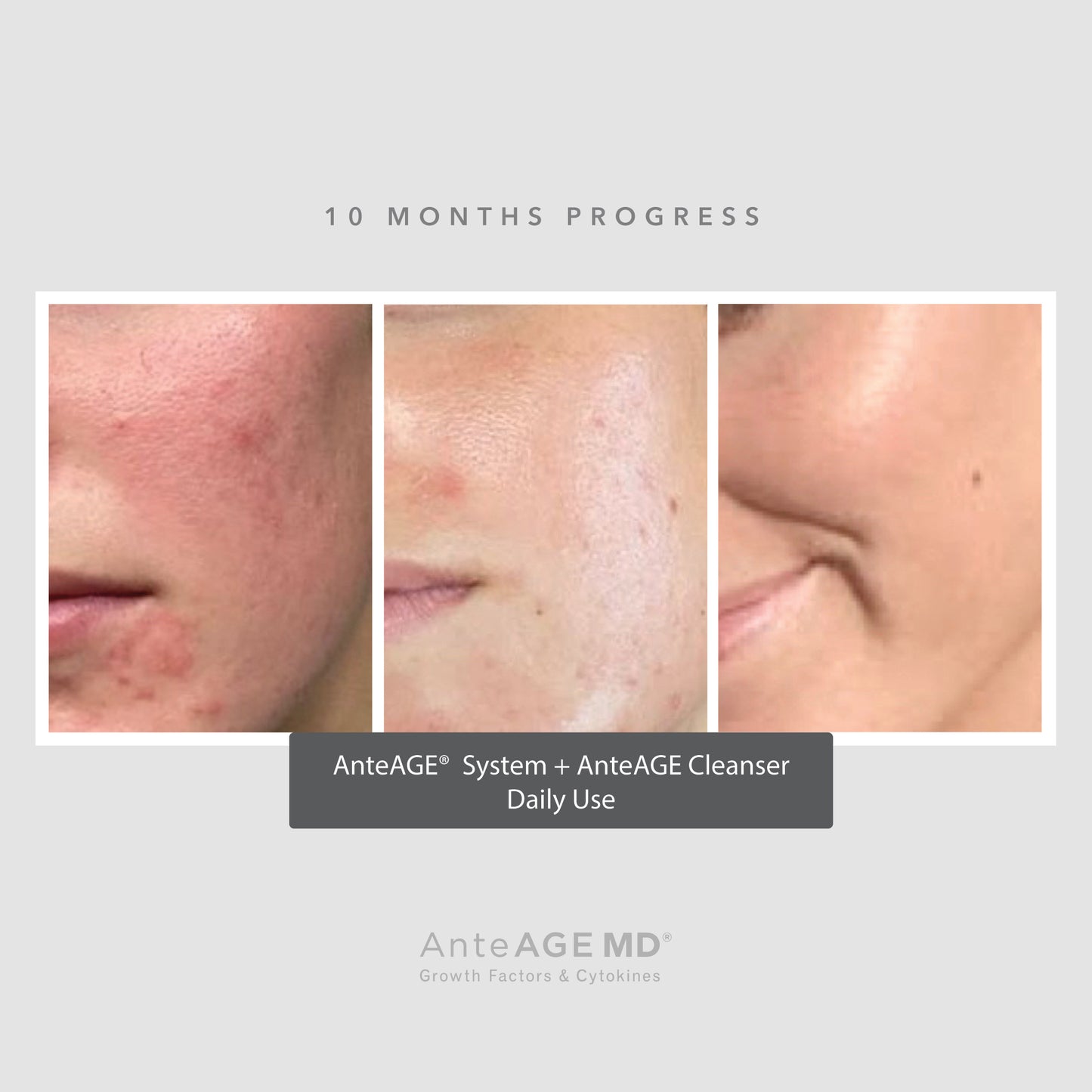 AnteAGE MD® Biosome™ System